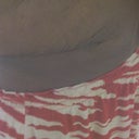 A close up of the scar from the side, two weeks post-op. This is as bad as the scar gets. Considering what I was expecting, not so bad, especially for only two weeks post-op.