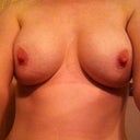 with implants.
