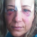 Day 1 (day after surgery)
