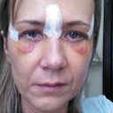 Day 6 (see one eye has Chemosis )