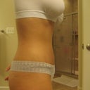 2 weeks 1 day- swelling going down!