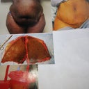 Right after surgery what a difference!!!! I'm soooo happy!!