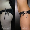 Before & After Side View 