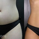 Before & After Stomach