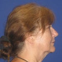 Before photo 2