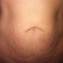 Pre op belly