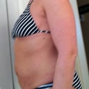 Pre op side view