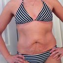 Pre op bikini