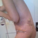 bruising from lipo
