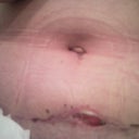 2weeks6days post op ...incision opening