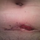 3weeks 2 day  post op....open incision, not expected to be healed for several more weeks