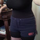 3 weeks post op with compression garment