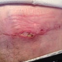 "Spitting sutures".  Dr said its fine, keep clean an dry, and it's ok when pulling off gauze it rips. It's removing the dead cells :). (Sideways!)
