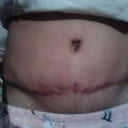 I had to laugh when I noticed it is a heart shape Belly Button.. 21 days post op