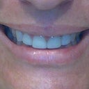 After Botox... Left side droopy
