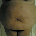 I am 1 week post opp and feeling a tad better,but gas is still killing me. My drains were removed at 6 days post opp.