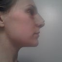 Day 1 Post op Side view. Not the greatest picture, but you can definitely see a difference.