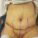 Nurse took this immediately following the surgery.