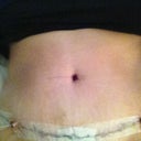 Post-op day 3, sorry its upside down