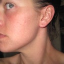 Photo taken straight out of the shower on March 23rd, almost 2 months after Faxel re:pair.  I still have some redness mainly right around my eyes