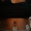 Day 2--Post-op