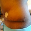 Left side 3wks PO