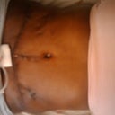 Scar 10 days post-op