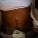 1 week--post-op
