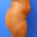 before side (posted on Dr. O's website)