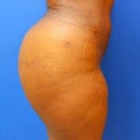 after side 6mon (posted on Dr. O's website)