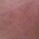Needle marks or tattoo from where she injected still present  