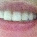 Saggy smile.  The doctors who told me I was too young for filler now think I need a face lift!