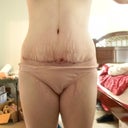 4 weeks post op