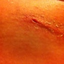 Day 12 right scar. Pin hole opening cause I couldn't help it and picked at it.