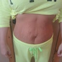 Before, HOLY stretch marks! ugh!!!