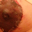 nipple wound bleeding
