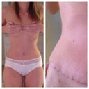 16 Days PO. Nice thin scar.