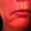 6 hours later. 2 days later face looks like chipmunk