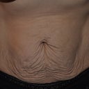 Before - Tummy Close Up. I think it looked like a Shar-Pei wrinkle dog's skin! :)