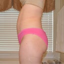 1 month PO side - doesn't look any different from 10 days PO - maybe even worse?!