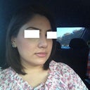 Right after Splint removed 1 week after rhinoplasty
