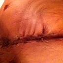 I can understand the skin is wrinkle at fisrt, pouched up like that?