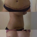 2weeks 397cc silicone under muscle/TT and hernia repair