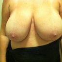 pre surgery 38 DDD-date: 7/15/12