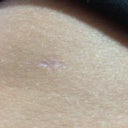 Lipo incision. It's tiny (smaller than a pencil eraser)