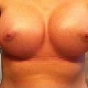 7 weeks post op. feeling more like natural breasts and dropping nicely.