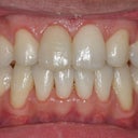 Maxillary Advancement And Canine Substitution