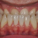 Maxillary Advancement And Canine Substitution