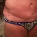 Scar at 6 weeks post op ... Swelling in flanks