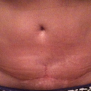 Scar at 6 weeks post op